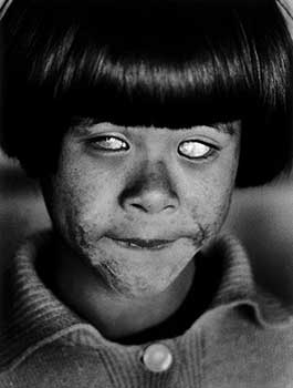 A Child Blinded from the Hiroshima Atomic Bomb (1945)